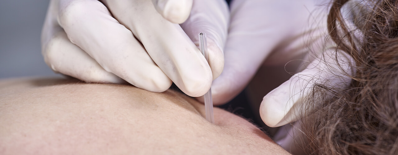 Functional Dry Needling Chatham, ON