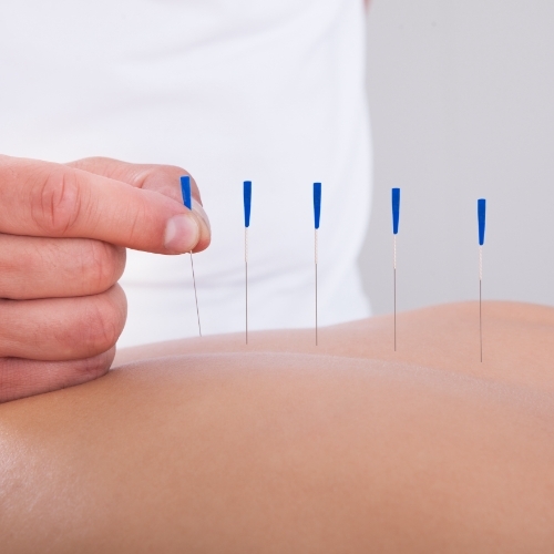 physiotherapy-center-functional-dry-needling-peach-physiotherapy-chatham-kent-on
