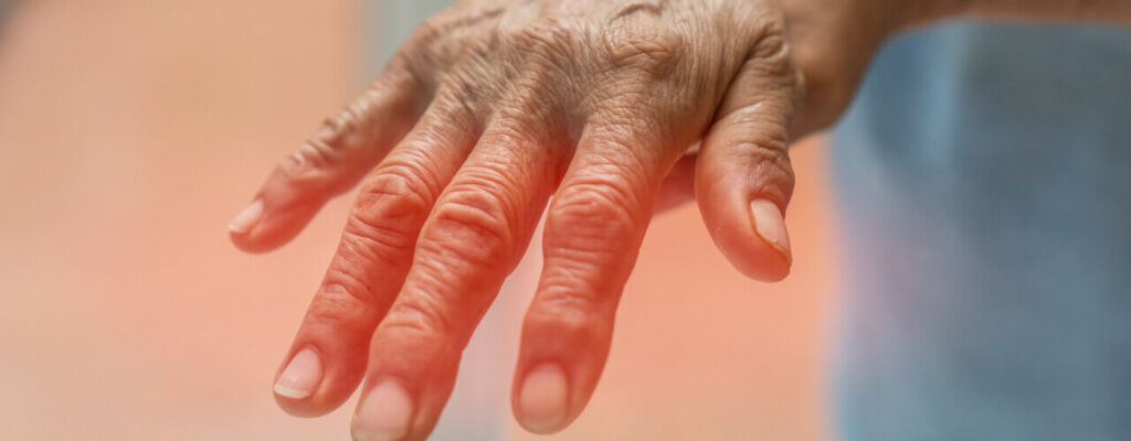Arthritis Can Be Exhausting – Physiotherapy Can Help